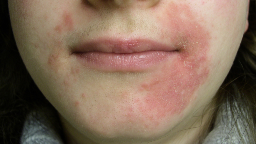 Orsakerna till perioral dermatit är inte klarlagda. Foto: Shutterstock